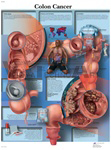 Colon Cancer - Anatomical Chart